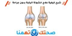 علاج خشونة الركبة بدون جراحة