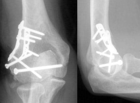 تثبيت العظام بالمسامير: تقنية جراحية حديثة لتحسين الشفاء والتئام الكسور