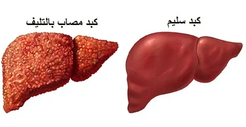 تليّف الكبد