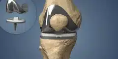 عملية تغيير مفصل الركبة: دليلك الكامل للجراحة والتعافي