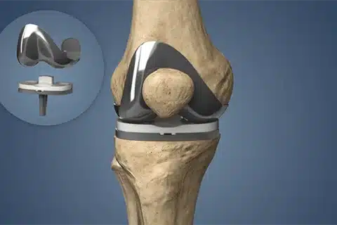 عملية تغيير مفصل الركبة: دليلك الكامل للجراحة والتعافي
