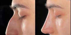 متي تظهر نتائج عملية تجميل الانف و اهم النصائح بعد العملية ؟ مع استاذ دكتور أحمد الشريفة استشاري جراحات التجميل