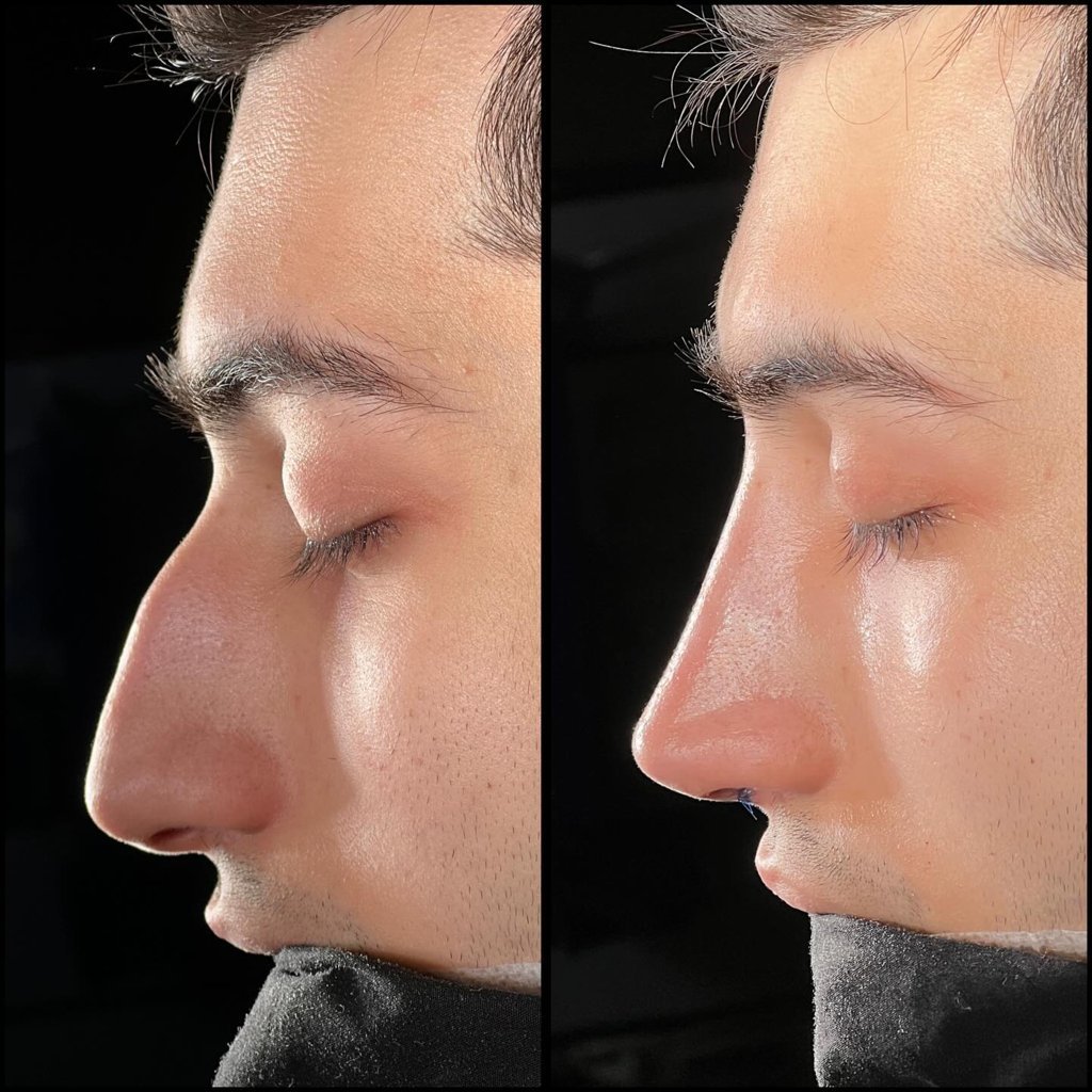 عملية تجميل الانف
